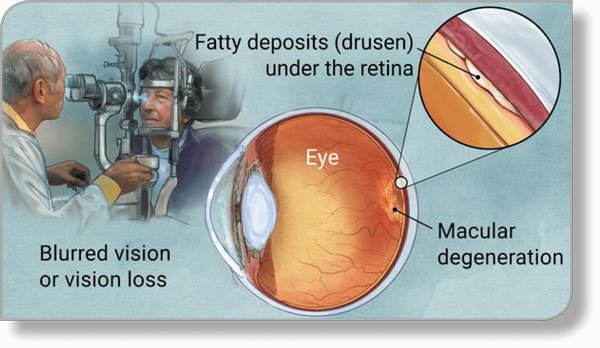 Macular-Degeneration-Diagram